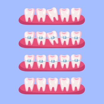 Teeth before and after braces cartoon illustration set. Stages of dental alignment or treatment with usage of brackets for beautiful smile. Orthodontist, healthcare, medicine concept