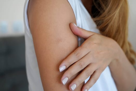 Young woman showing vaccination scar mark on the skin of her arm