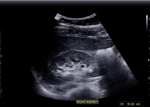 Ultrasound of Kidney  or KUB  for  screening  renal stone disease.