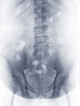 X-ray image of lumbar Spine  or L-s spine lateral view for diagnosis lower back pain.