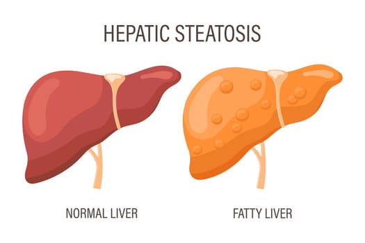 Liver steatosis, liver diseases. Healthy liver and fatty liver. Medical infographic banner.