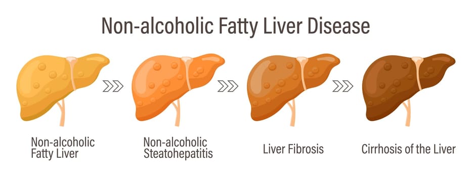 Types of fatty liver. Human liver diseases. Non-alcoholic fatty liver disease. Hepatitis, liver cirrhosis, fibrosis, steatosis. Medical infographic banner.