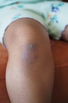 stain bruise wound on child knee.