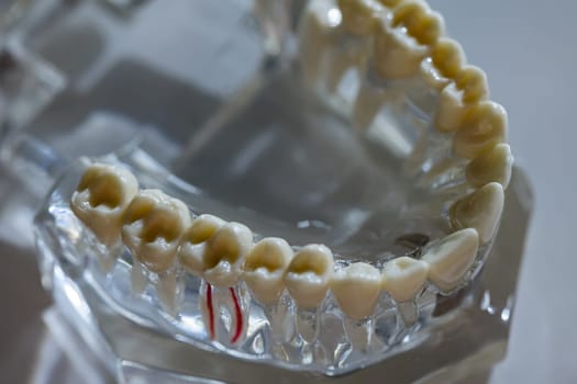 Dental model present common dental disease such as caries, wisdom tooth. Oral health. Copy space.