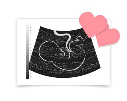 Photograph of an ultrasound of an unborn baby embryo and red hearts.