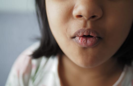 close up of dry lip of a child