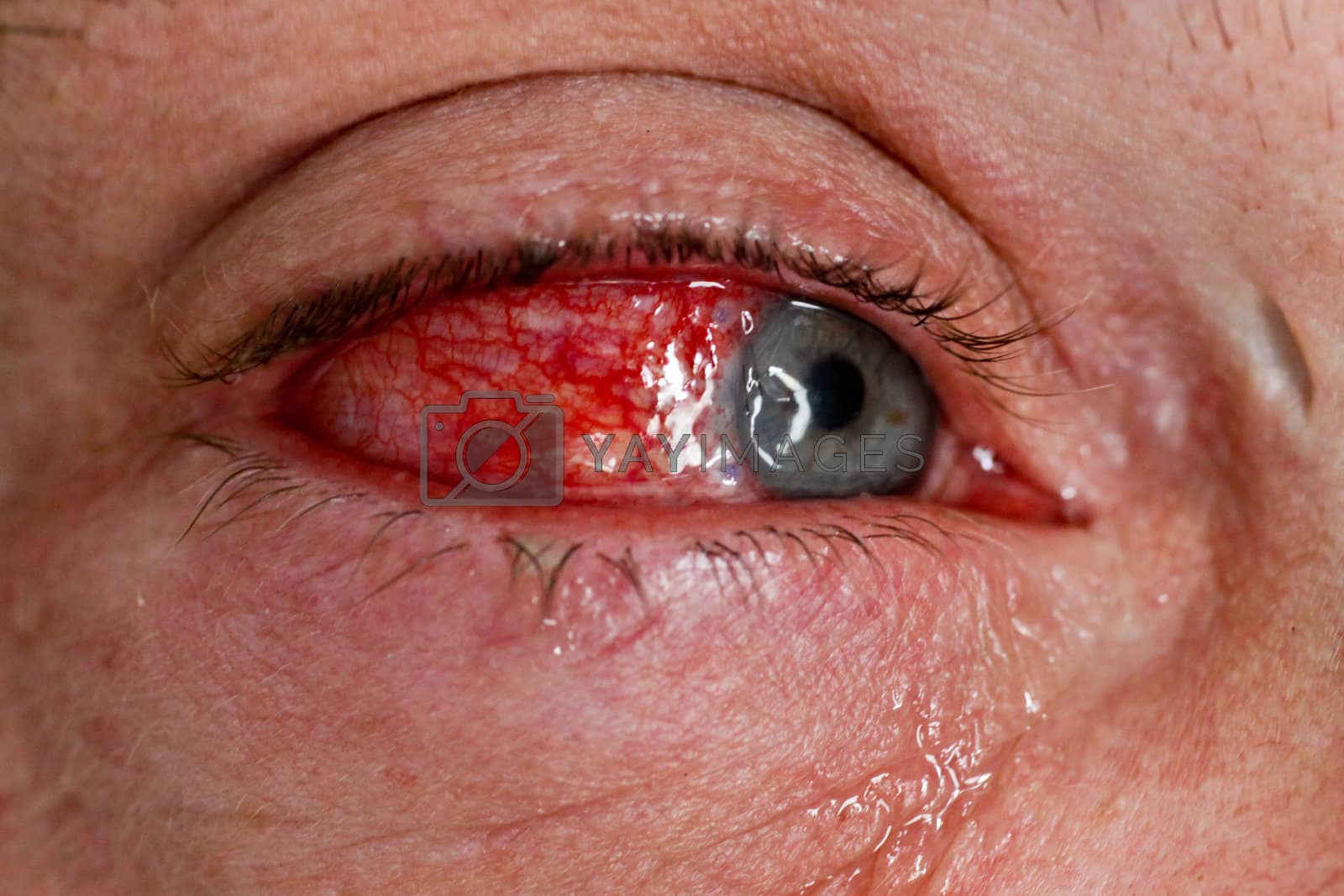 Royalty free image of Eye injury - close-up by Farina6000
