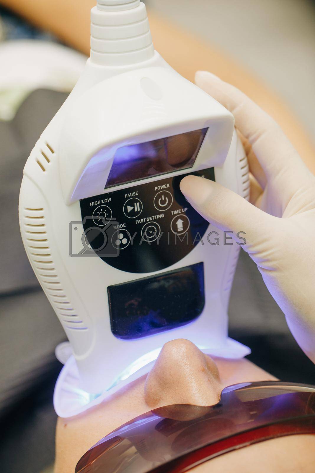 Royalty free image of Teeth whitening using an ultraviolet lamp. Dentist doing teeth whitening procedure with ultraviolet lamp. Concept of teeth care and dentistry. by uflypro