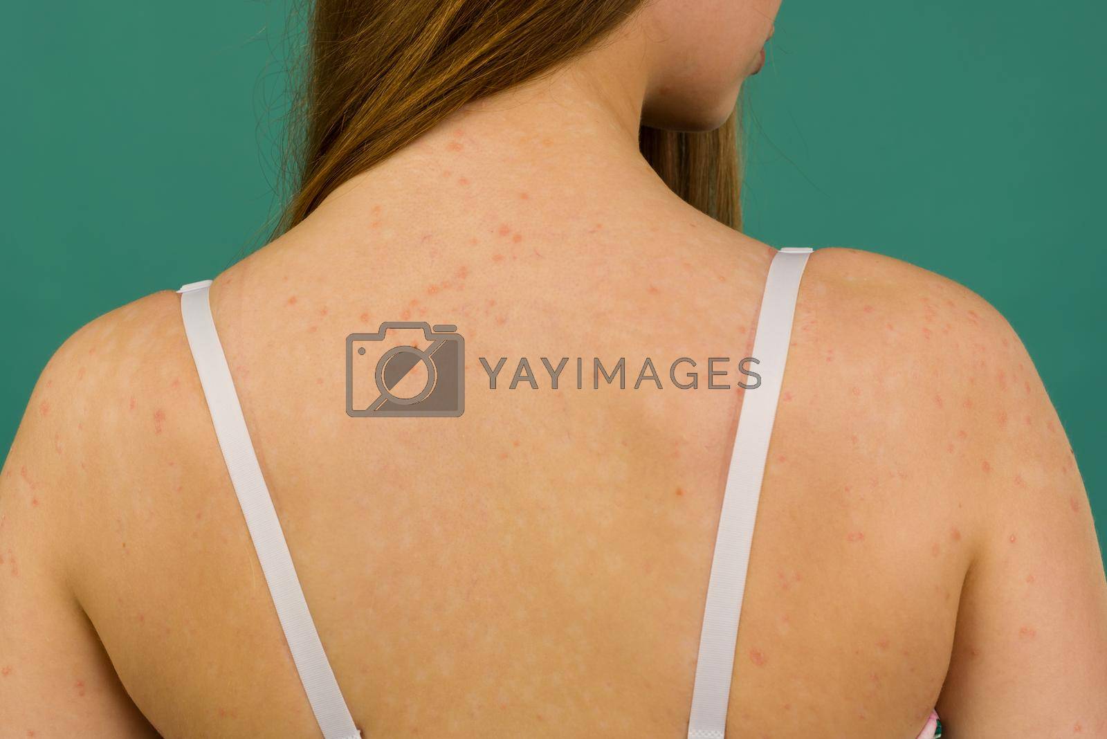Royalty free image of CLOSE UP: Unrecognizable young woman suffering from autoimmune incurable dermatological skin disease called psoriasis. by zartarn