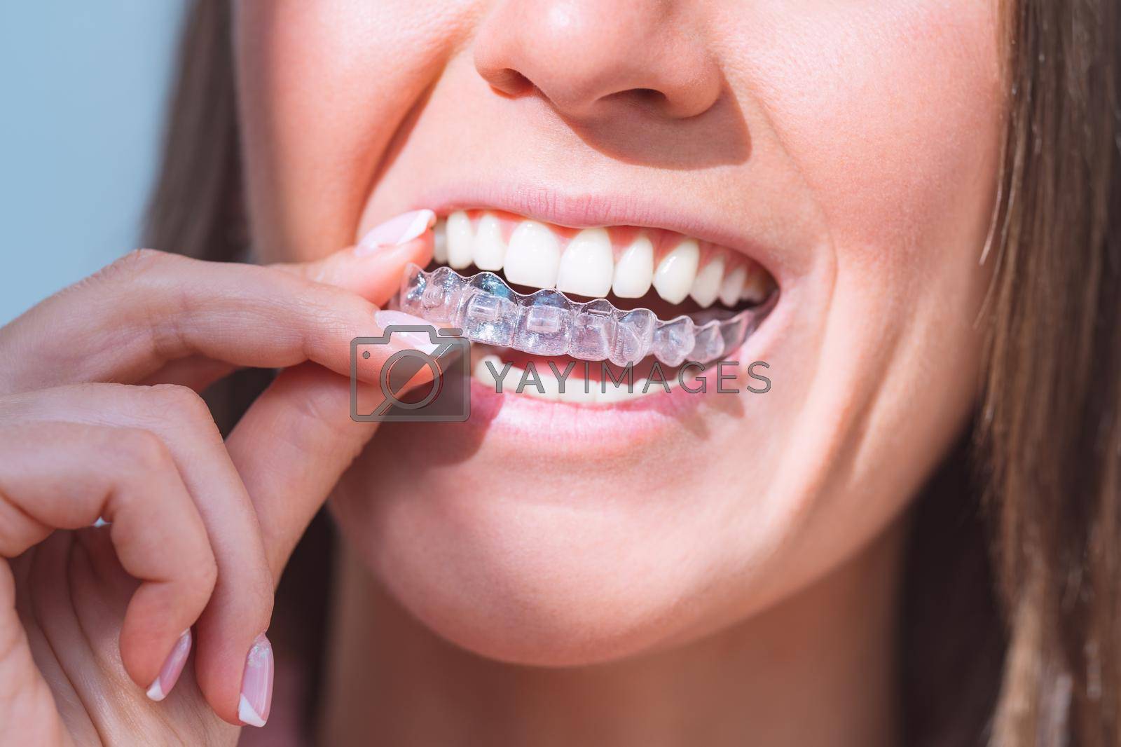 Woman with perfect smile wearing invisible dental aligners for dental correction. High quality photo
