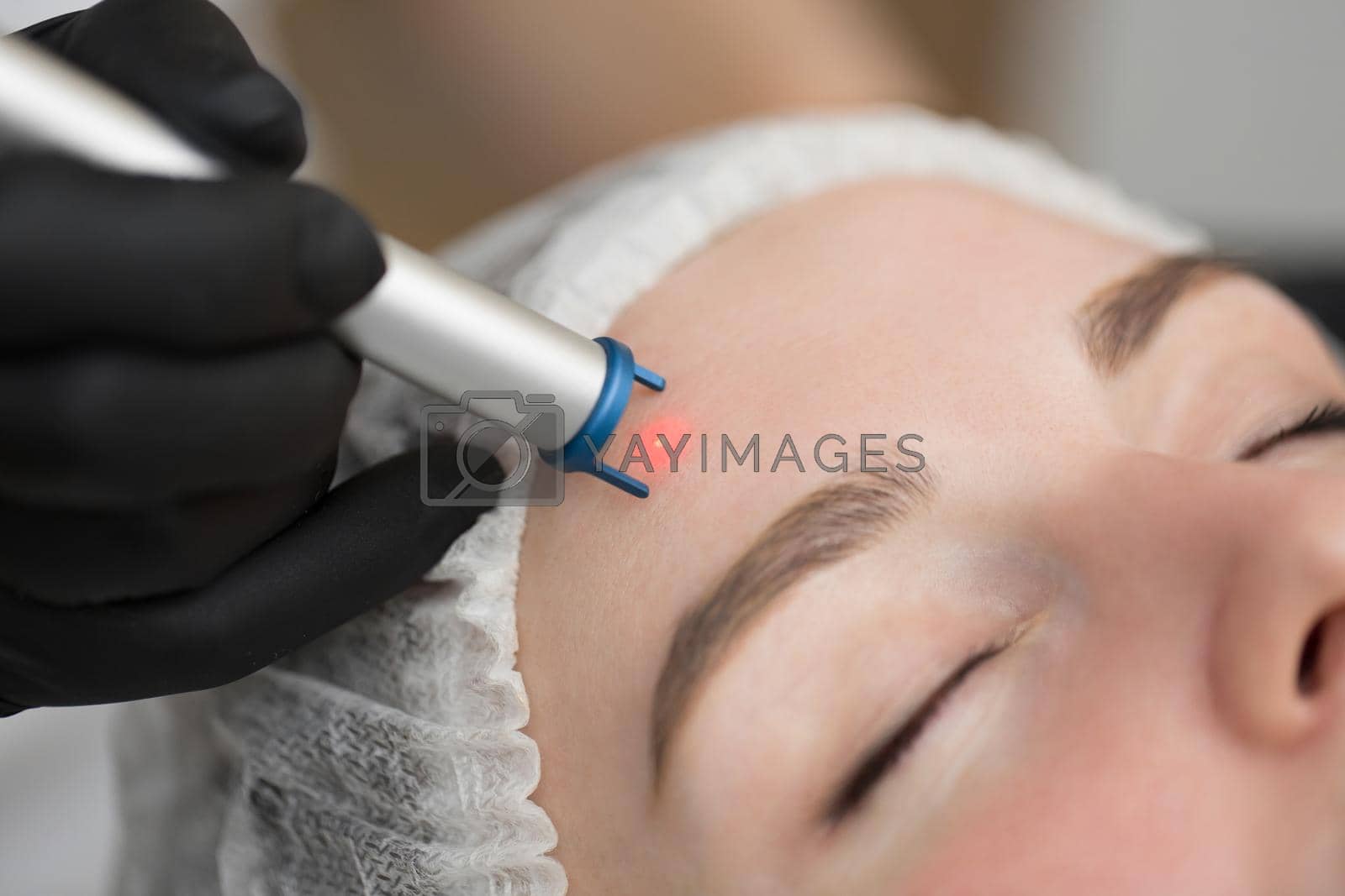 Royalty free image of Close-up removal of blood vessels on the face of a diode laser in a cosmetic clinic. Therapist beautician makes a laser treatment to young woman's face at beauty SPA clinic. by StudioPeace