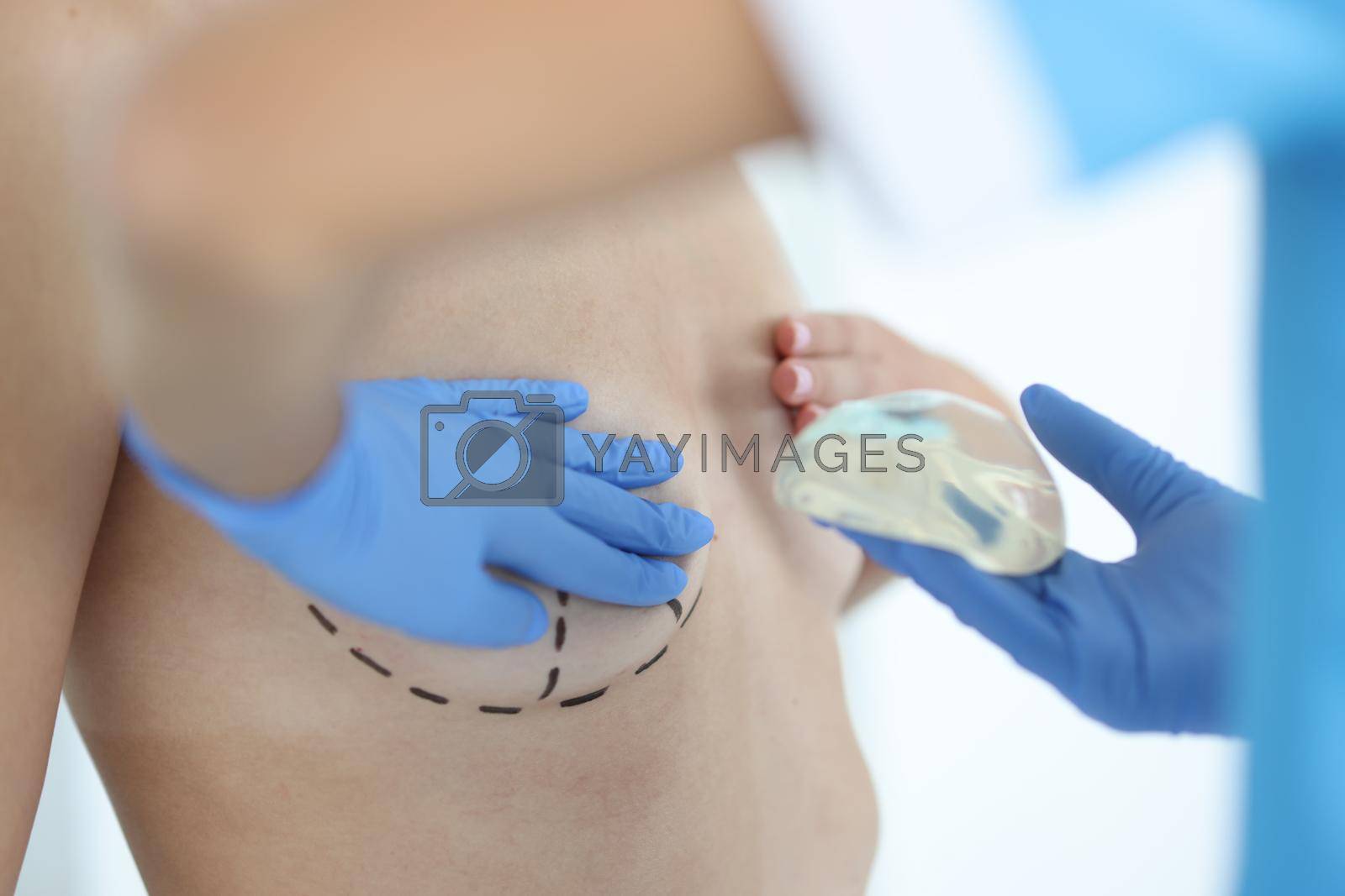 Royalty free image of Plastic surgeon holds silicone chest implant for breast augmentation by kuprevich