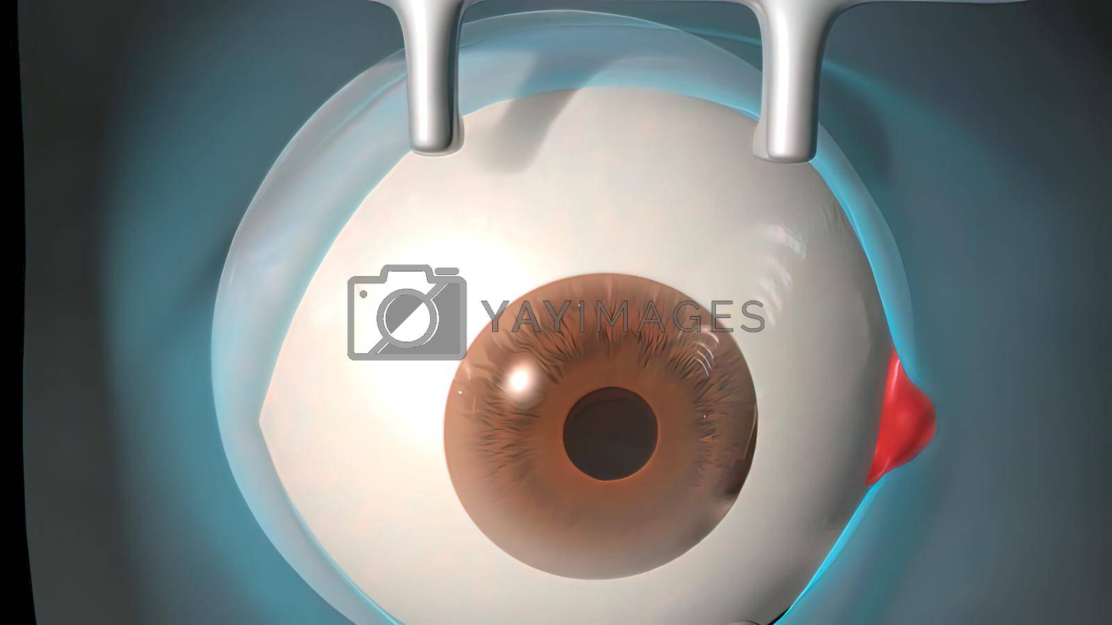 Royalty free image of Cataract surgery application view Surgical operations on the human eye by creativepic