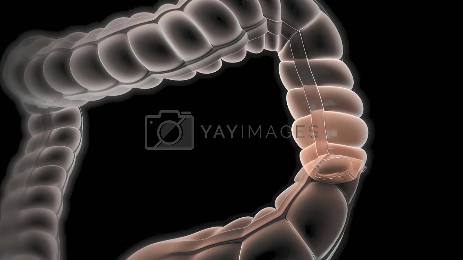 Royalty free image of surgery to remove any part of the intestines, bowel resection by creativepic