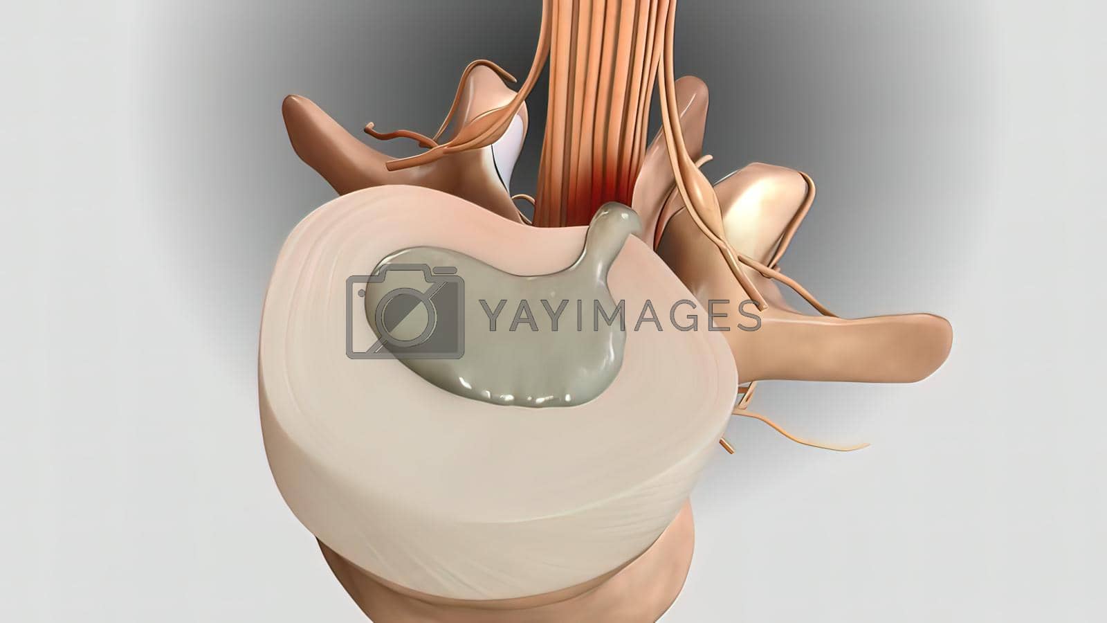 Royalty free image of Pressure applied to the nerve as a result of the fracture of the spinal disc by creativepic