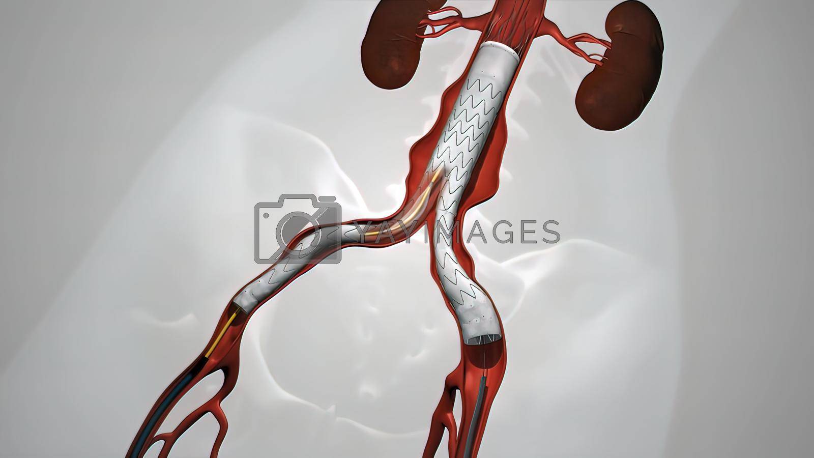 Royalty free image of balloon angioplasty procedure with stent in vein by creativepic