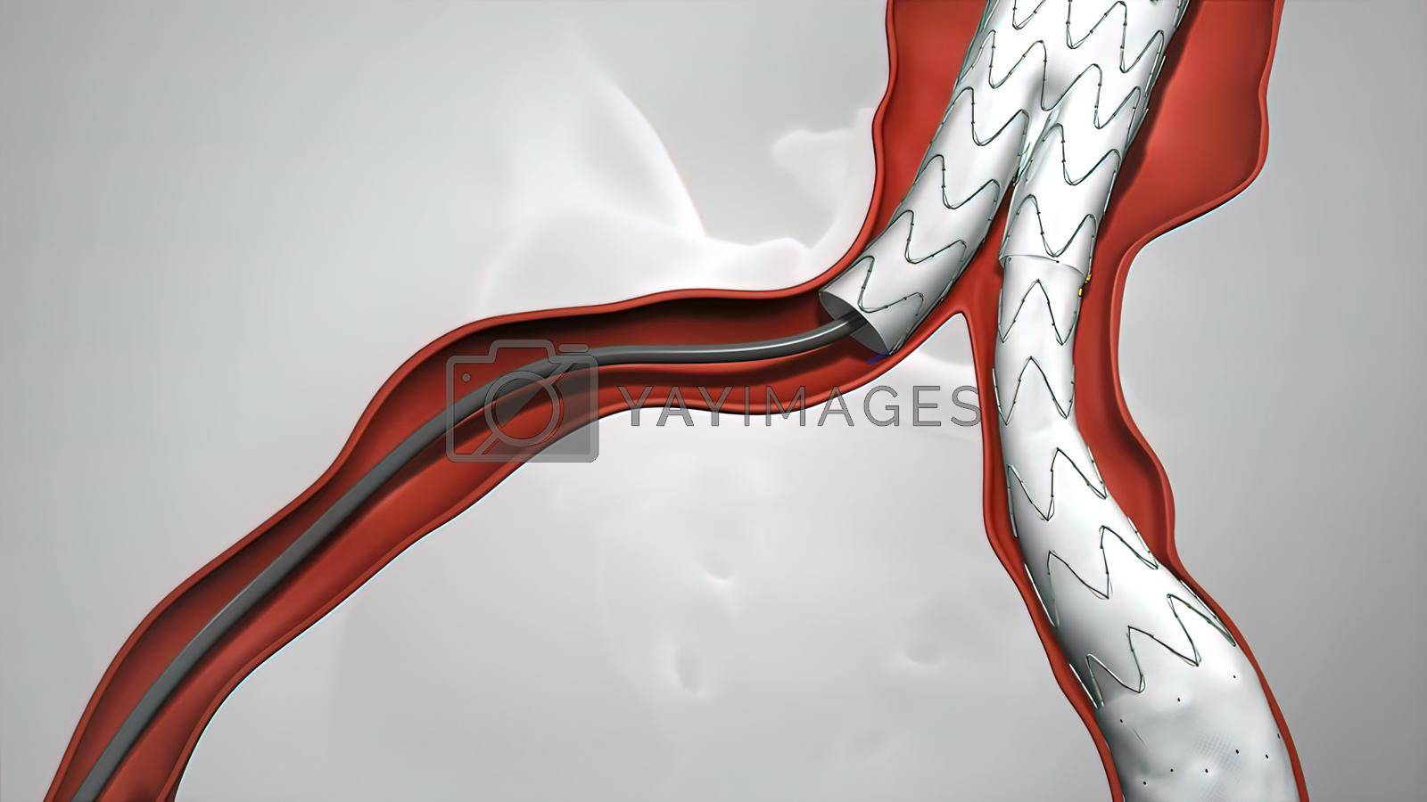 Royalty free image of balloon angioplasty procedure with stent in vein by creativepic
