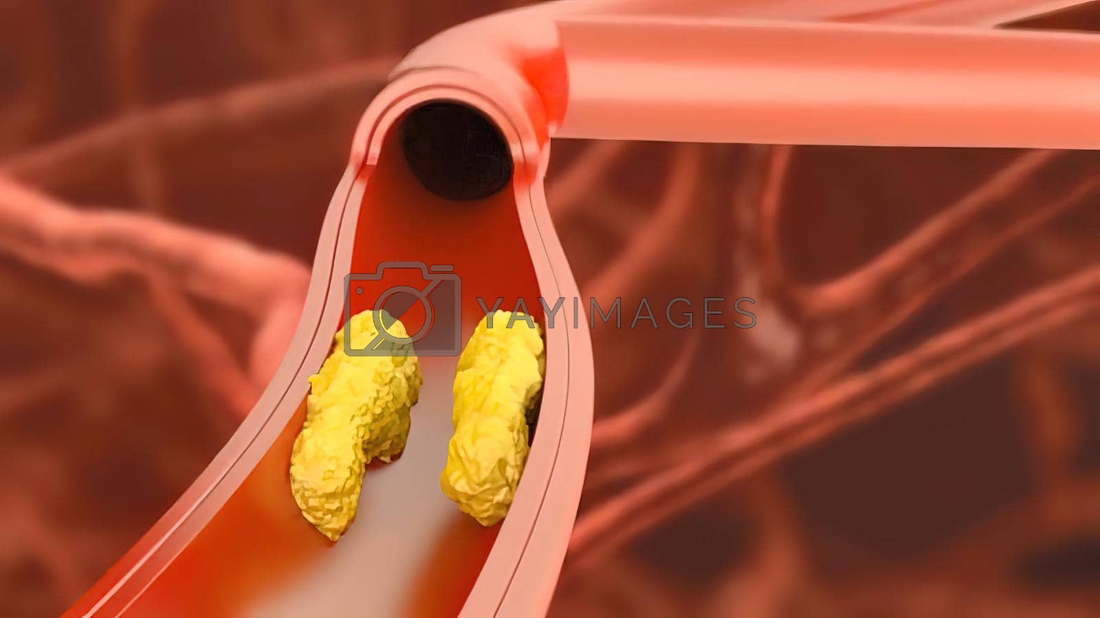 Royalty free image of Atherosclerosis, plaque buildup and thickening of the arteries in the inner lining of an artery 3D medical illustration by creativepic