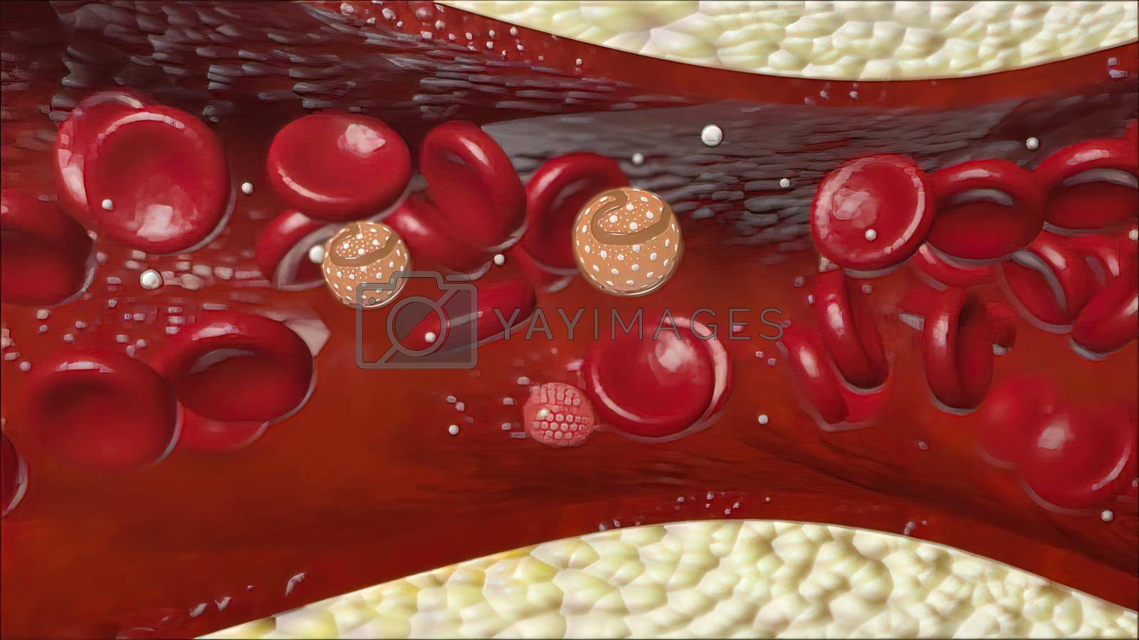 Royalty free image of Atherosclerosis with cholesterol blood or plaque in vessel cause of coronary artery disease by creativepic