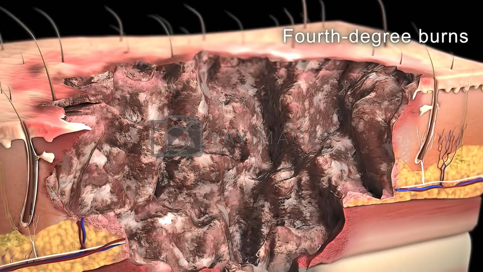 Royalty free image of First Degree Burn epidermis 3d by creativepic