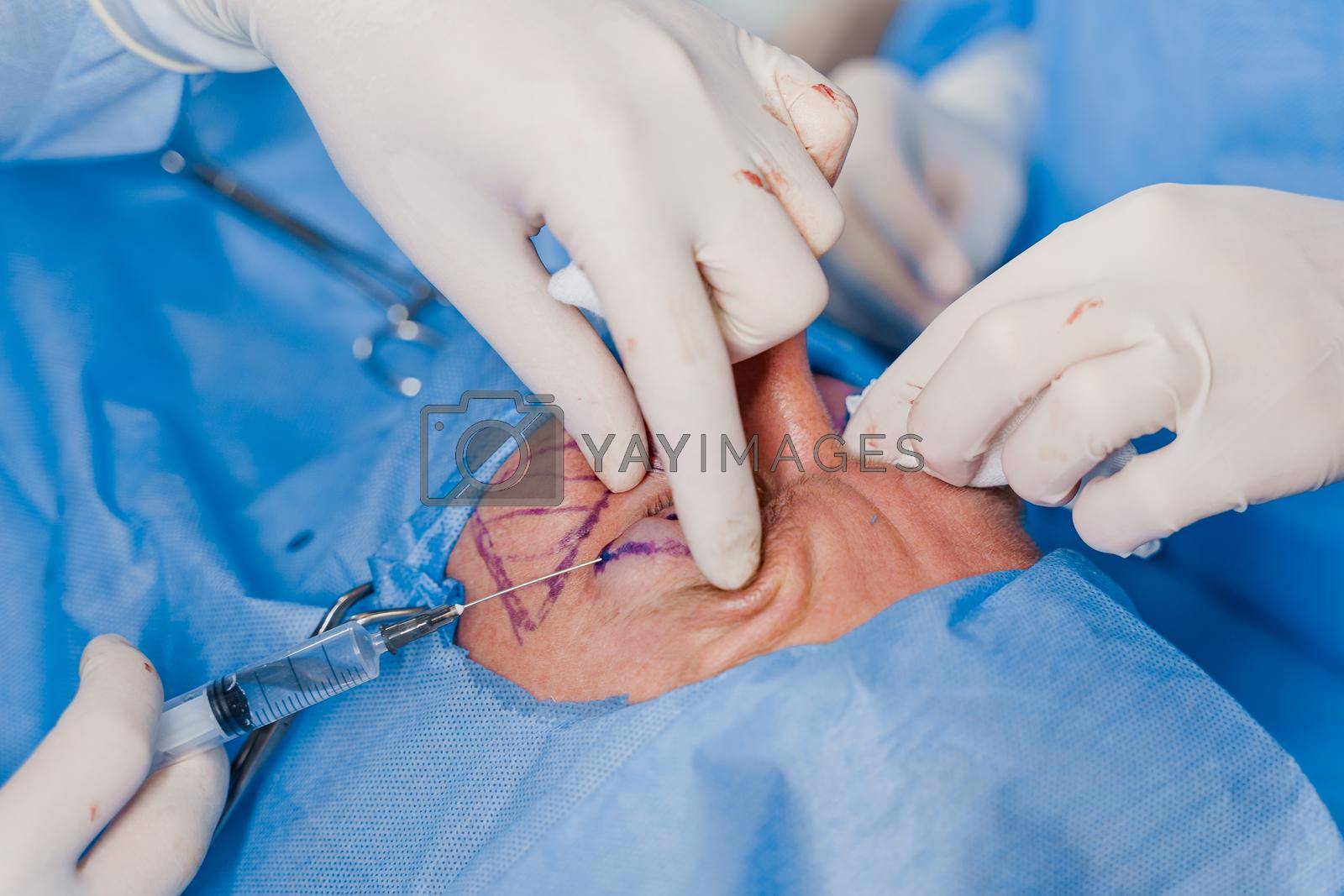 Royalty free image of Close-up anesthesia before blepharoplasty and lipofilling plastic surgery operation for modifying the eye region of the face in medical clinic. by Rabizo