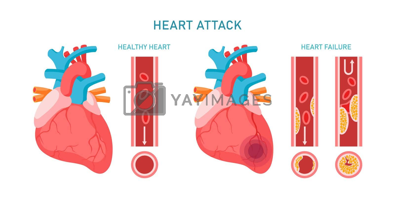 Royalty free image of Heart attack and cardiovascular diseases infographic. Healhty and failure hearts, atherosclerosis symptoms and diagnosis. Flat vector illustration. Design for medicine, treatment, health care concept by jatmikaV