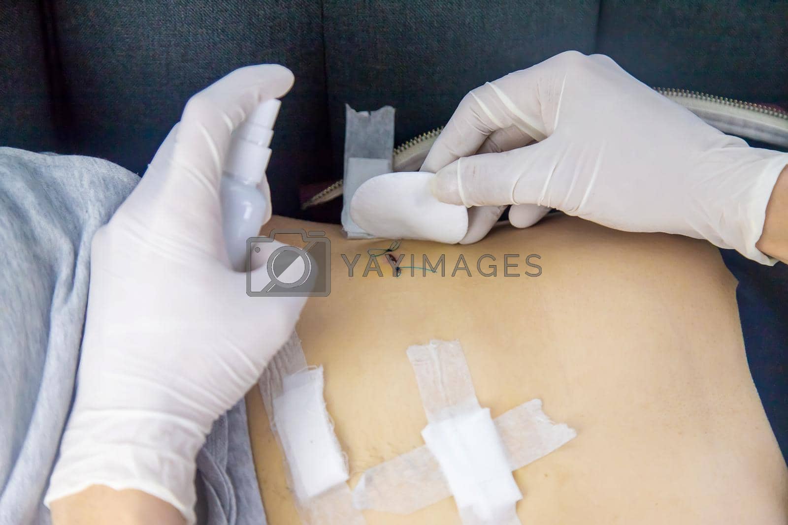 Royalty free image of Examination of the patient by a doctor after removal of the appendix Selective focus by Anuta23