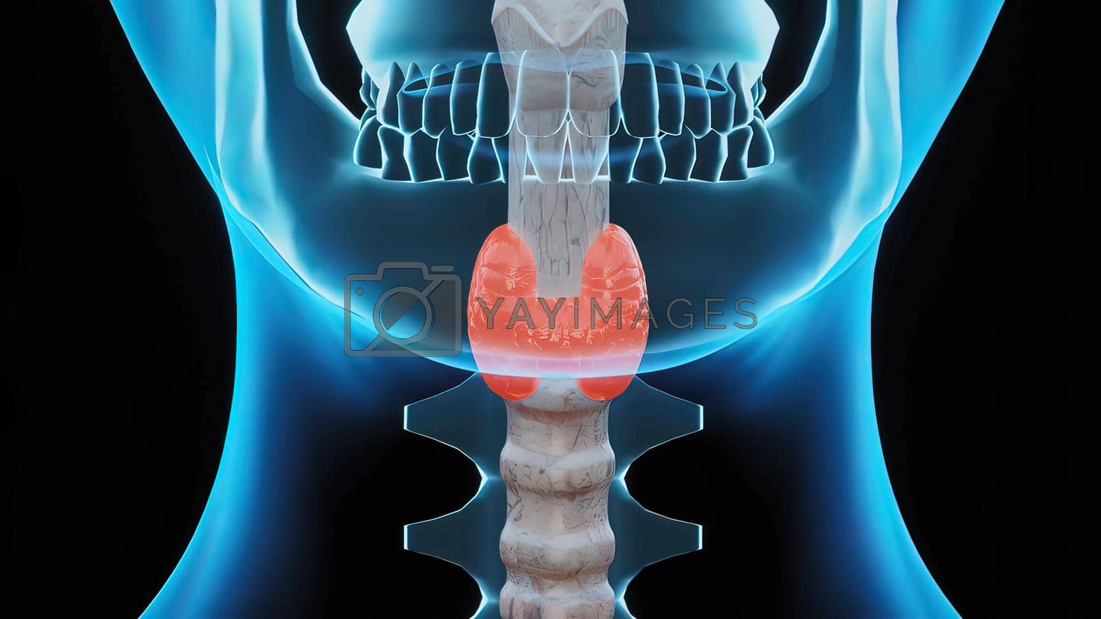 Royalty free image of Nodular goiter occurs when the thyroid gland does not produce enough thyroid hormone for the body by creativepic