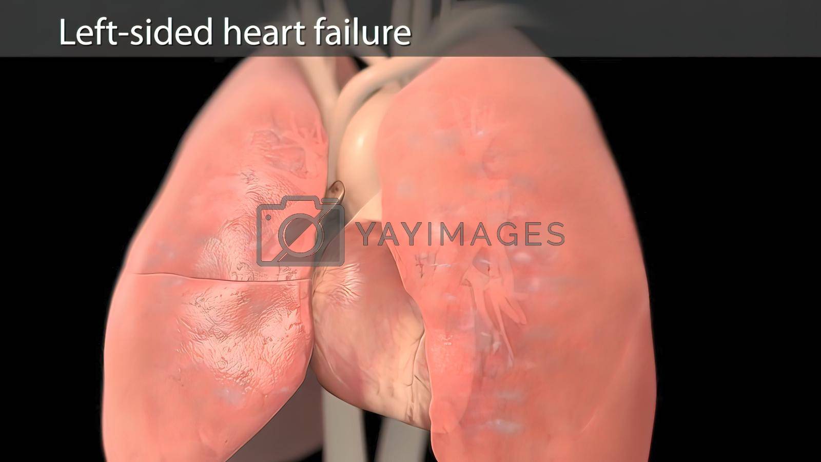 Royalty free image of left sided heart failure 3d by creativepic
