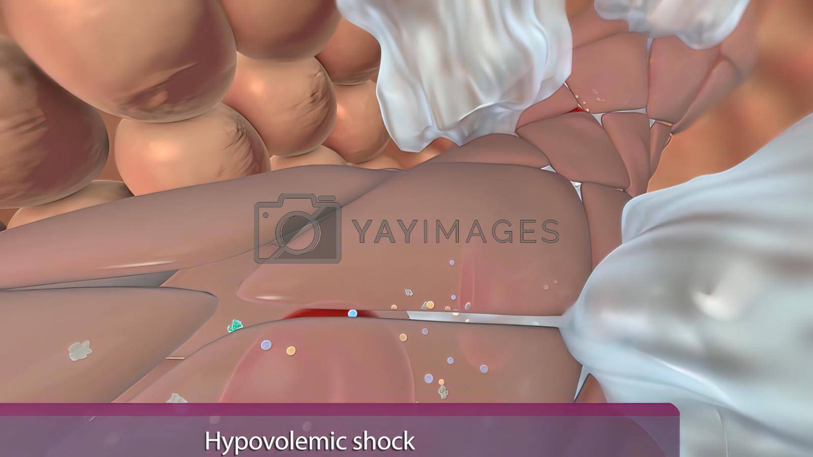 Royalty free image of Hypovolemic shock occurs due to low fluid volume in the intravascular system. by creativepic