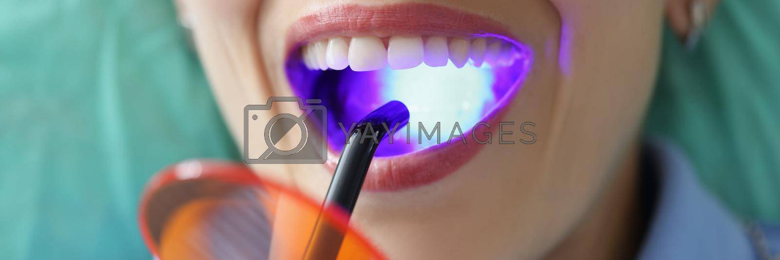 Royalty free image of Woman with open mouth on dentist appointment try whitening procedure by kuprevich