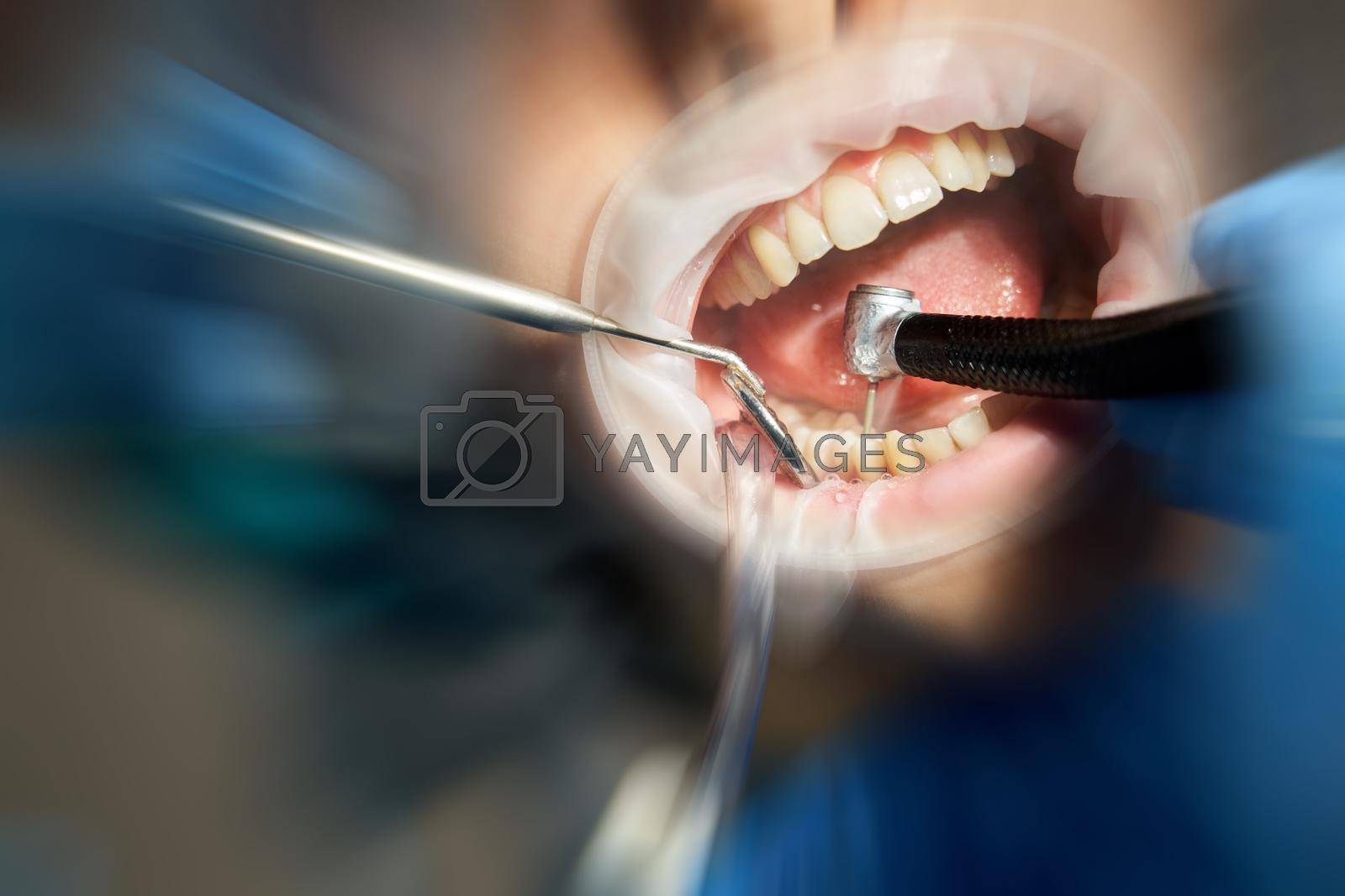 Royalty free image of dentist drilling tooth to male patient in dental chair with motion blur effect by Mariakray