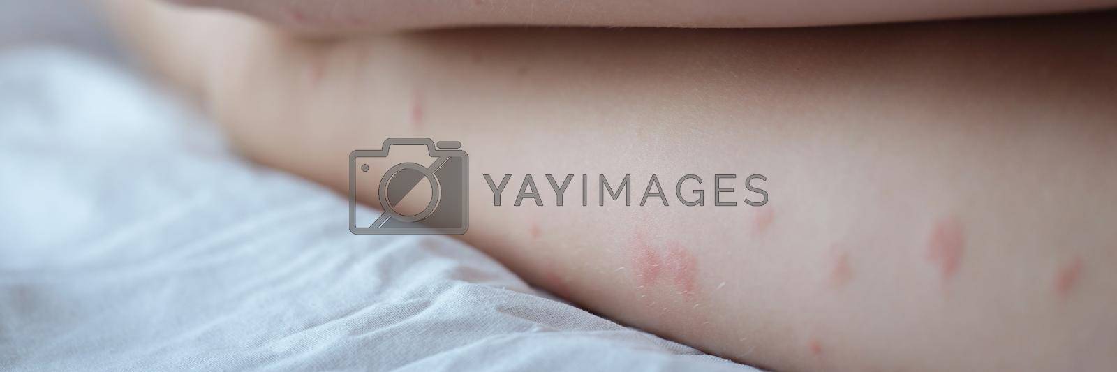 Royalty free image of Red rash on the white skin of female legs, pimples by kuprevich