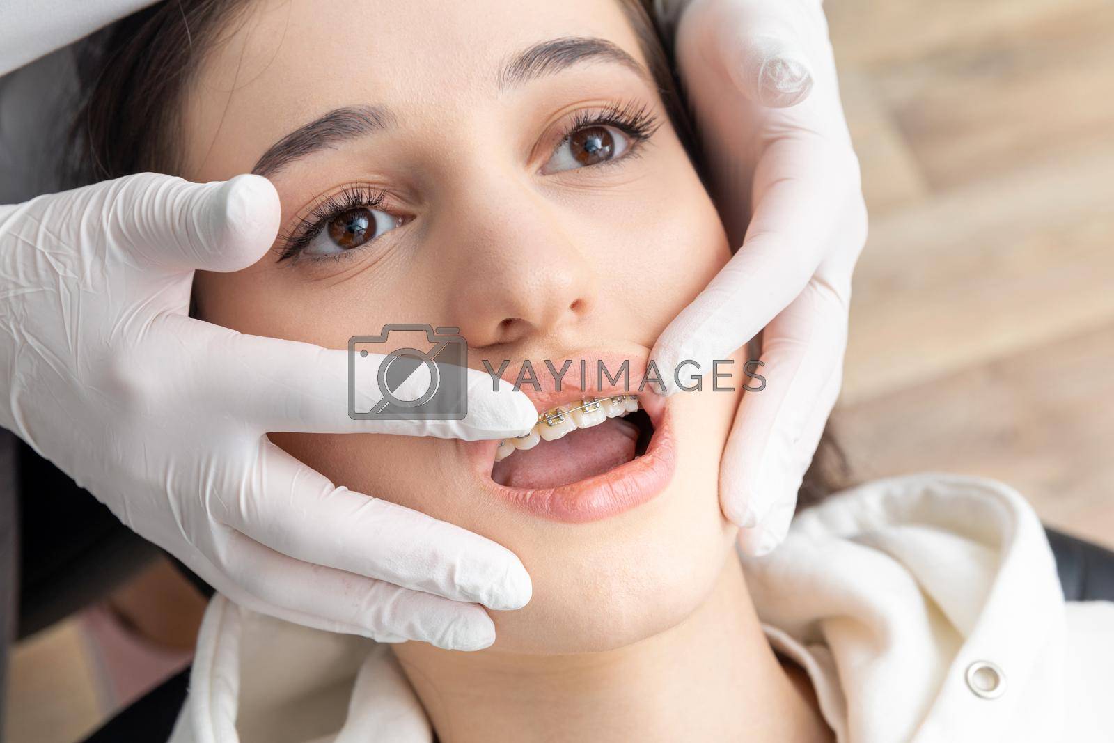 Royalty free image of Close up of orthodontist checking brackets on female teeth. Concept of stomatology, dentistry, orthodontic treatment of braces by Mariakray