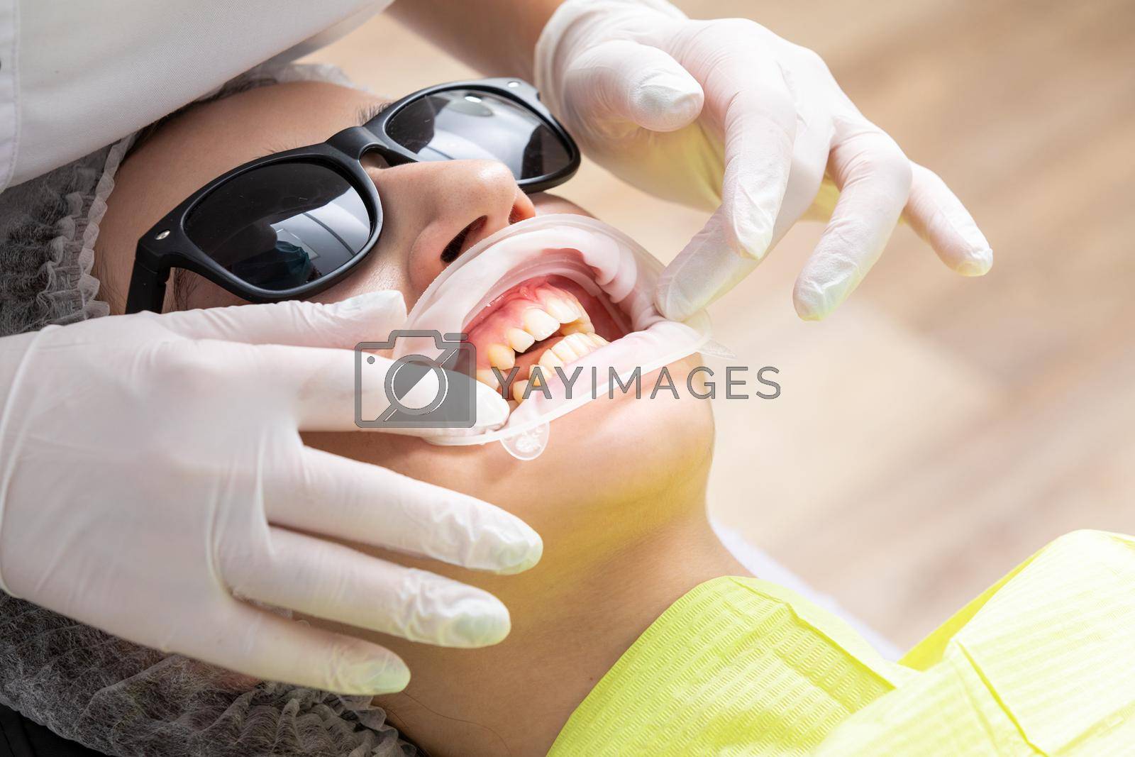 Royalty free image of Dentist installing a patient cheek retractor in dentist office by Mariakray
