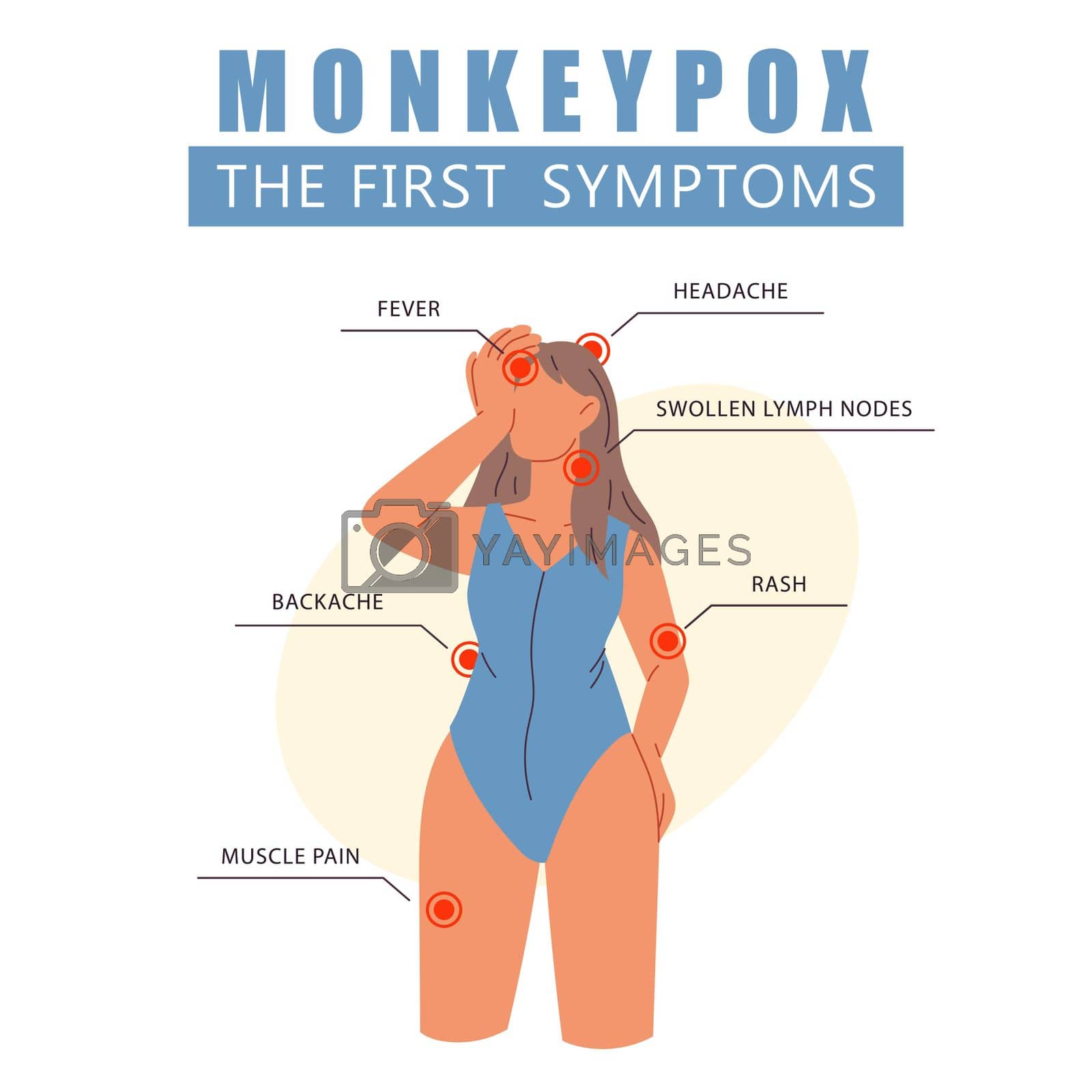 Royalty free image of Monkeypox virus the first symptoms. Woman with fever, headache, rash. Information poster with symptoms of monkeypox virus. It cause skin infections. Flat vector illustration by vikalost