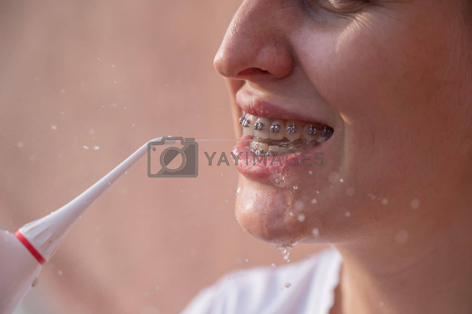 Royalty free image of A woman with braces on her teeth uses an irrigator. Close-up portrait. by mrwed54