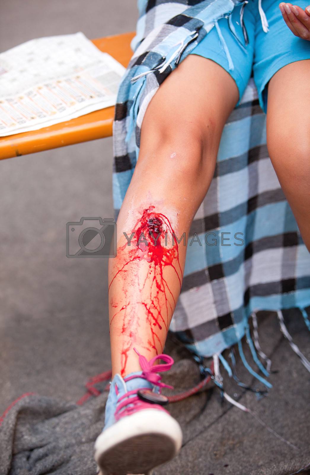 Royalty free image of Leg injury by wellphoto