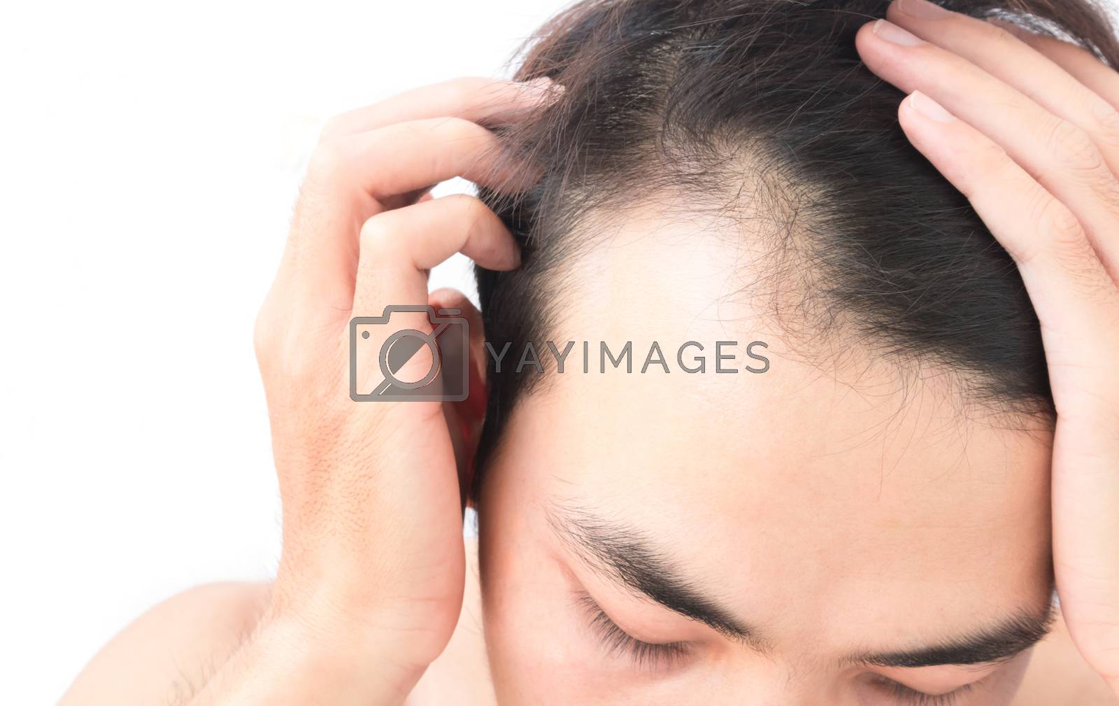 Royalty free image of Young man worry hair loss problem for health care shampoo and be by pt.pongsak@gmail.com