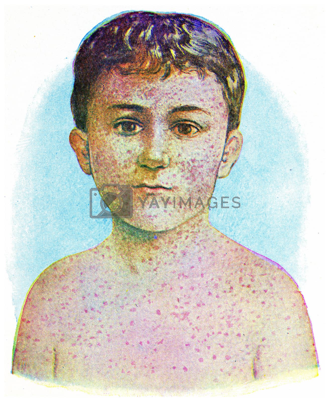 Royalty free image of Measles, vintage engraving. by Morphart