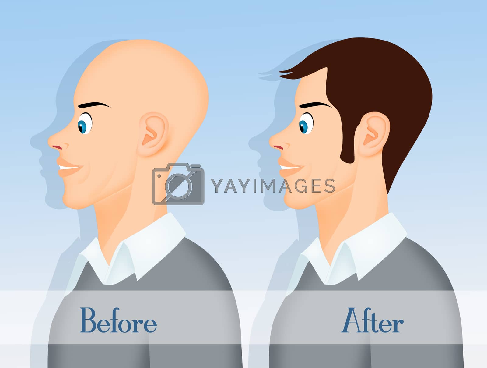 Royalty free image of before and after hair transplantation by adrenalina