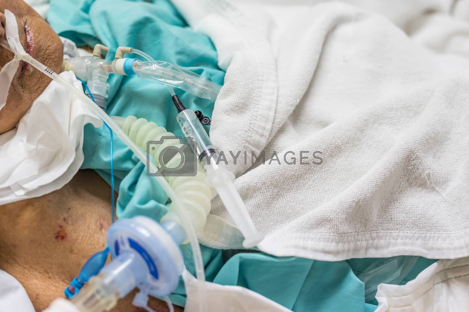 Royalty free image of Patient do tracheostomy and ventilator in hospital by PongMoji