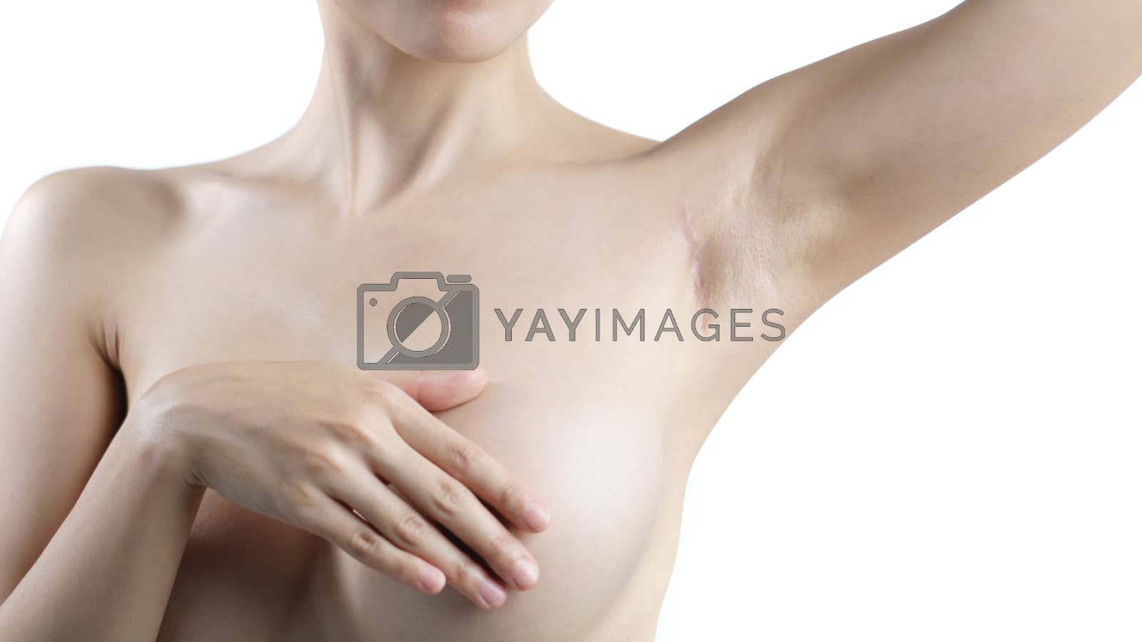 Royalty free image of Woman showing keloids or scar on the armpit after breast surgery by sirawit99