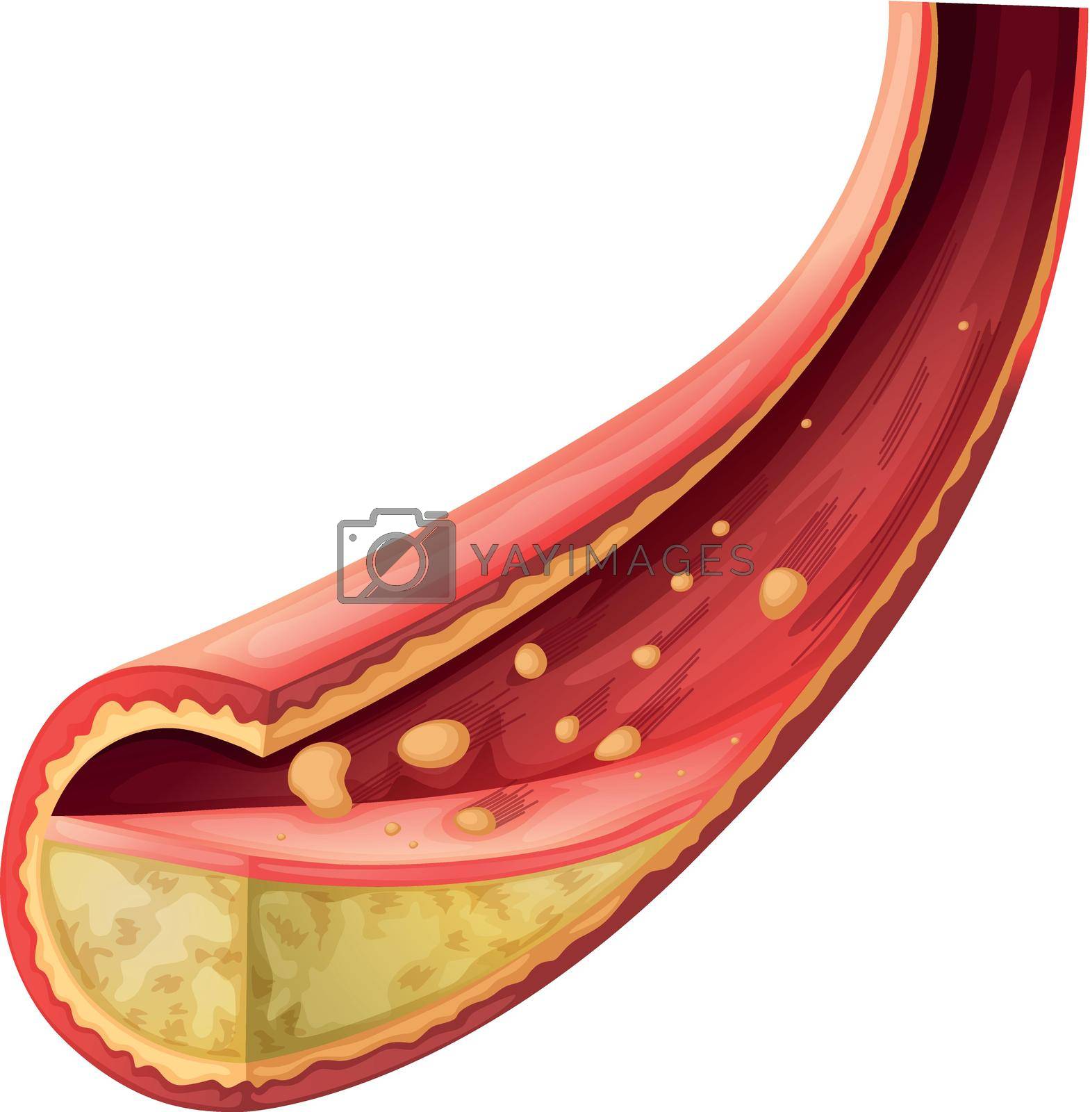 Royalty free image of Artery blocked with cholesterol by iimages