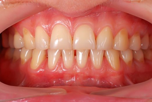 high resolution human teeth closeup