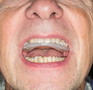Close up of teeth guard in senior mouth