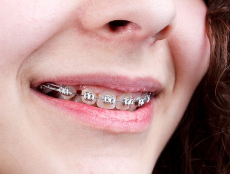 Woman with brackets 