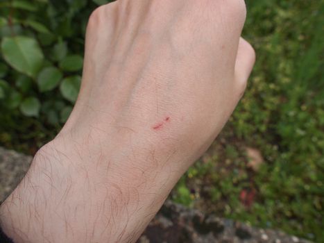 Hand scar