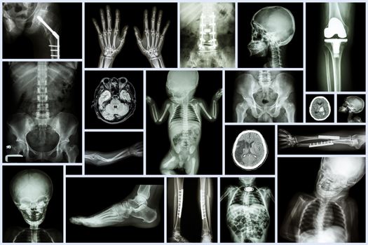Collection X-ray Multiple adult and child's organ & orthopedic surgery & multiple disease (Stroke , Osteoarthritis knee , Fracture bone , etc)