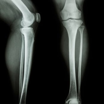 film x-ray leg & knee AP(Anterior-Posterior)/lateral